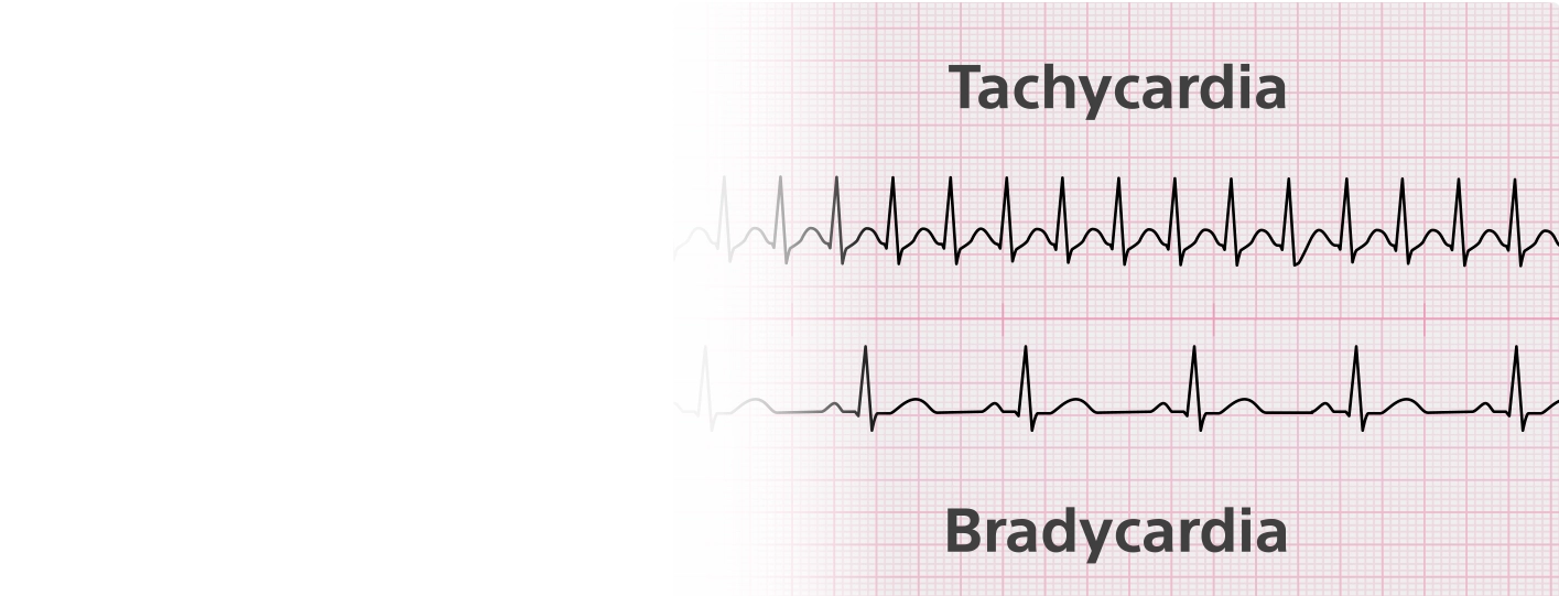 Bradycardia vs Tachycardia: What Is the Difference?